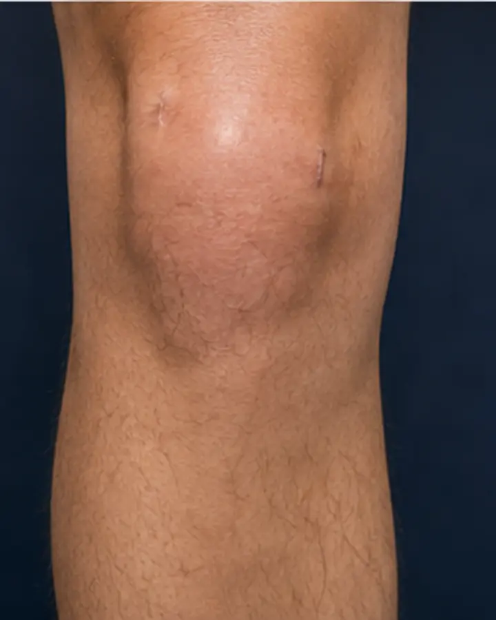 Person experiencing symptoms related to ACL reconstruction rehabilitation