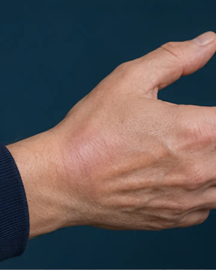 Person experiencing symptoms related to De Quervain’s tenosynovitis