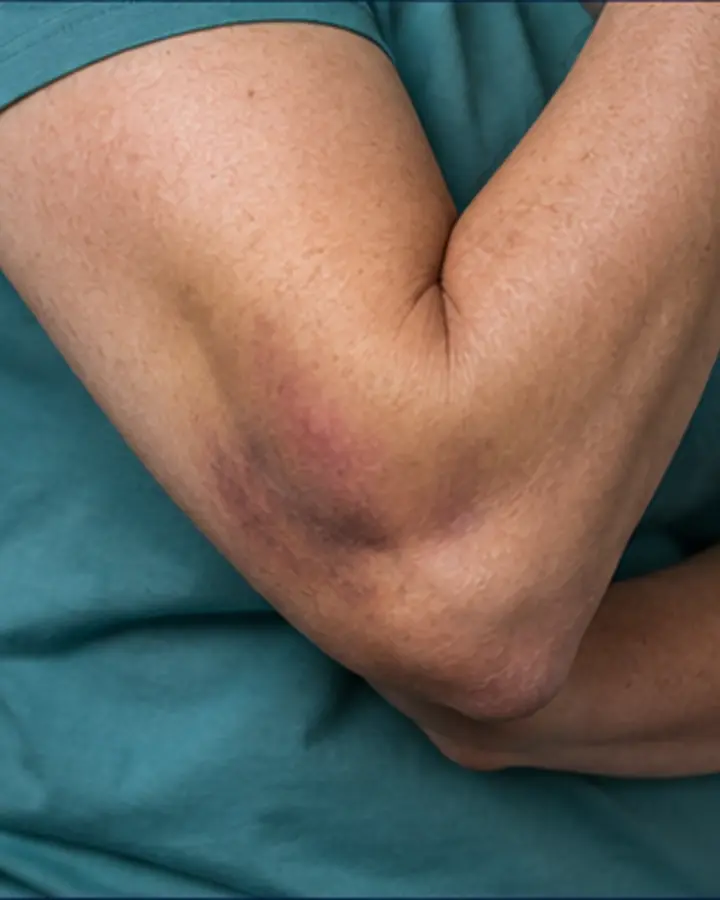 Person experiencing symptoms related to Elbow dislocation rehabilitation