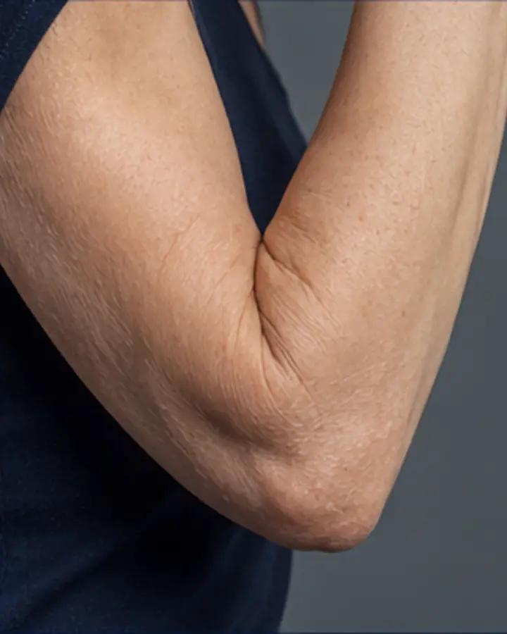 Person experiencing symptoms related to Elbow stiffness after immobilisation