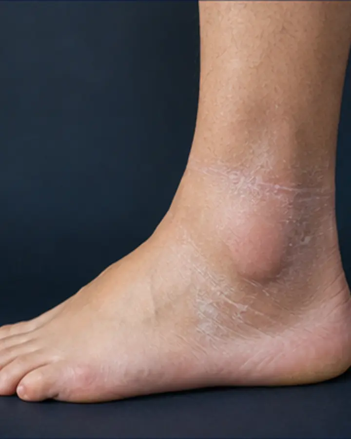 Person experiencing symptoms related to Fracture rehabilitation after a cast, brace or walking boot