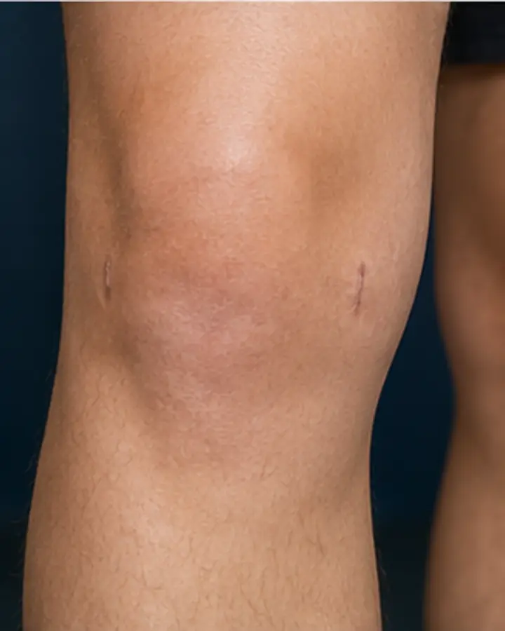 Person experiencing symptoms related to Knee arthroscopy rehabilitation