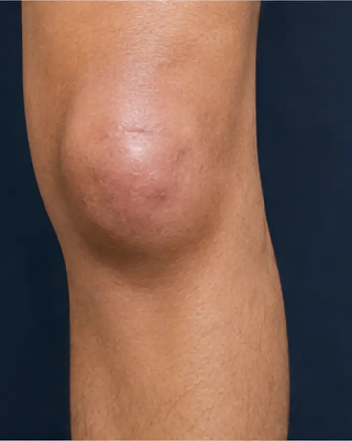 Person experiencing symptoms related to Patella fracture rehabilitation