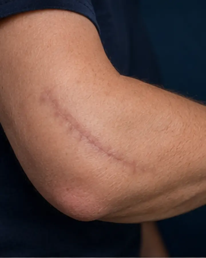 Person experiencing symptoms related to Post-operative elbow rehabilitation