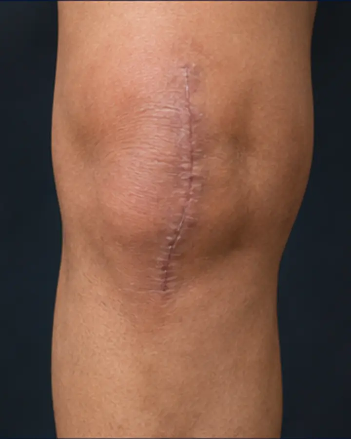 Person experiencing symptoms related to What to expect from post-operative physiotherapy