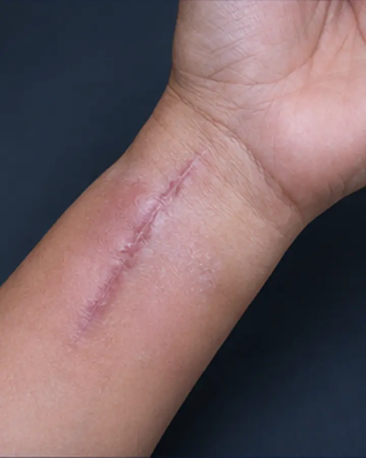 Person experiencing symptoms related to Post-operative wrist rehabilitation