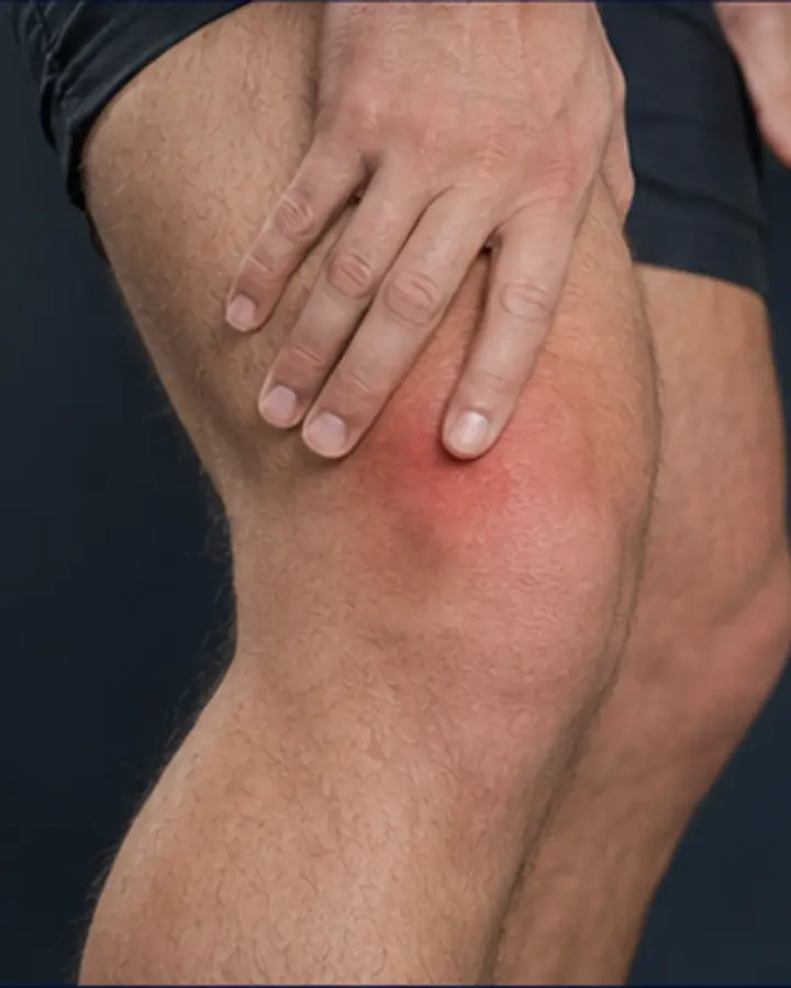 Person experiencing symptoms related to Quadriceps tendinopathy