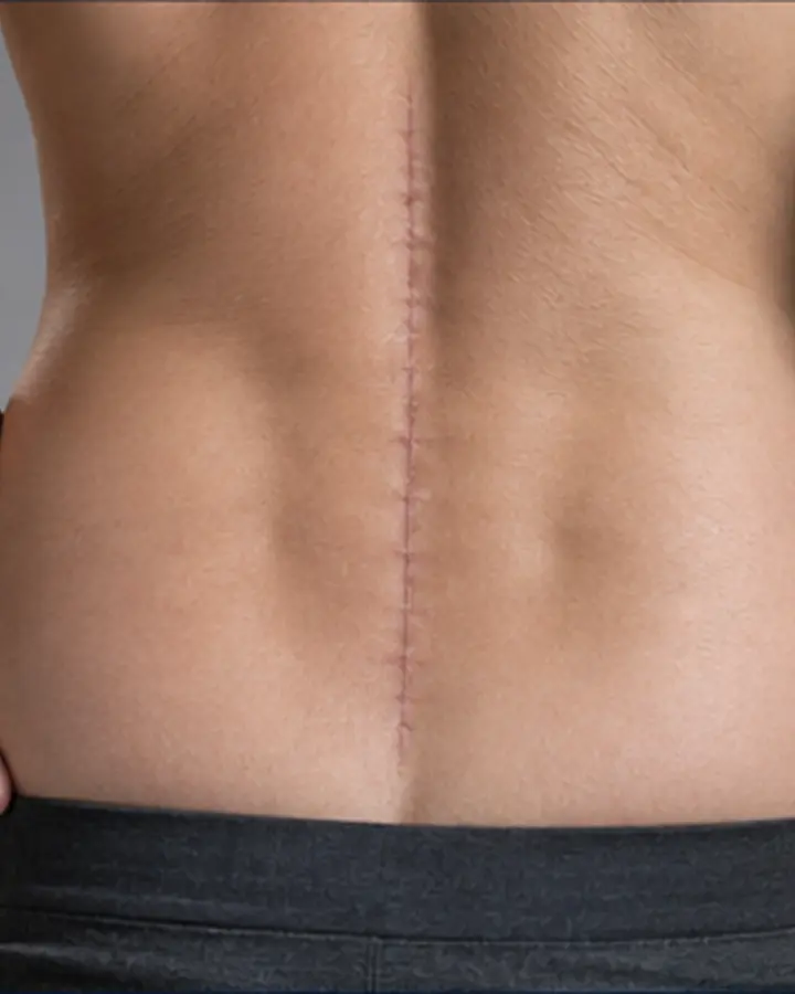 Person experiencing symptoms related to Rehabilitation after lumbar fusion