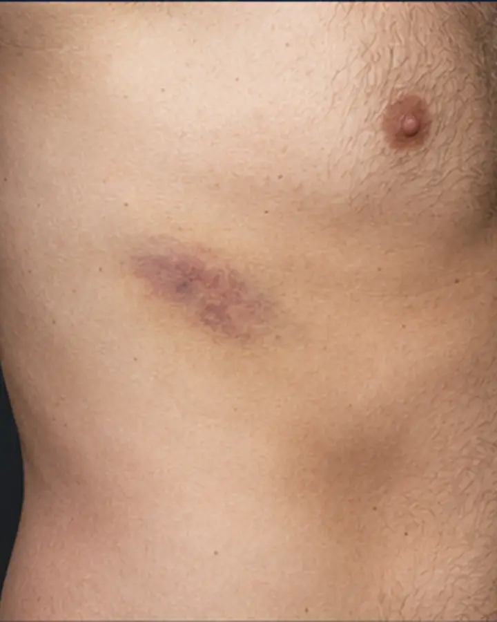 Person experiencing symptoms related to Rib contusion