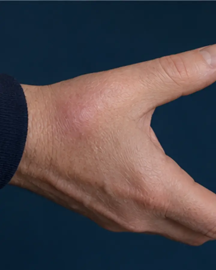 Person experiencing symptoms related to Scaphoid fracture rehabilitation