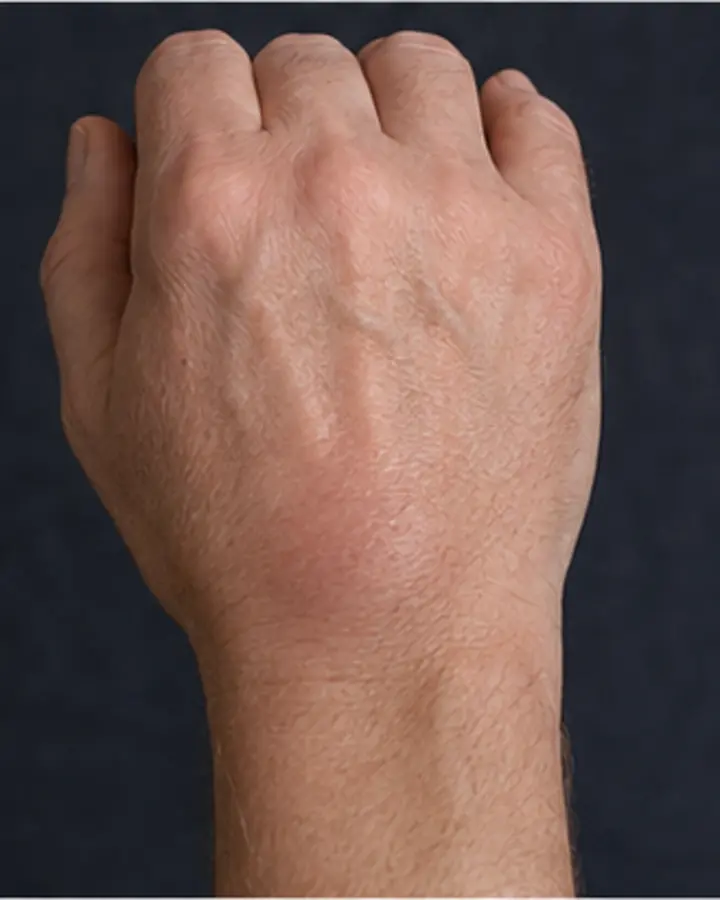 Person experiencing symptoms related to Scapholunate ligament injury