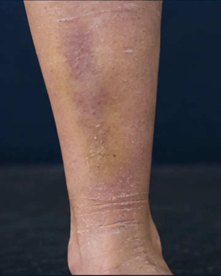 Person experiencing symptoms related to Tibia fracture rehabilitation
