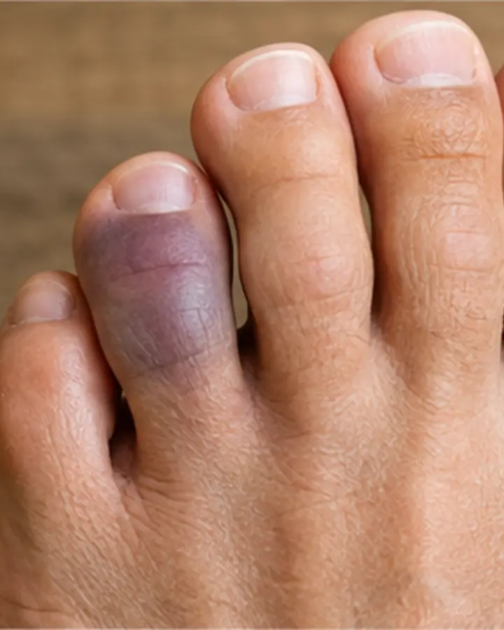 Person experiencing symptoms related to Toe fracture rehabilitation