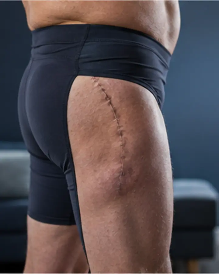 Person experiencing symptoms related to Total hip replacement rehabilitation