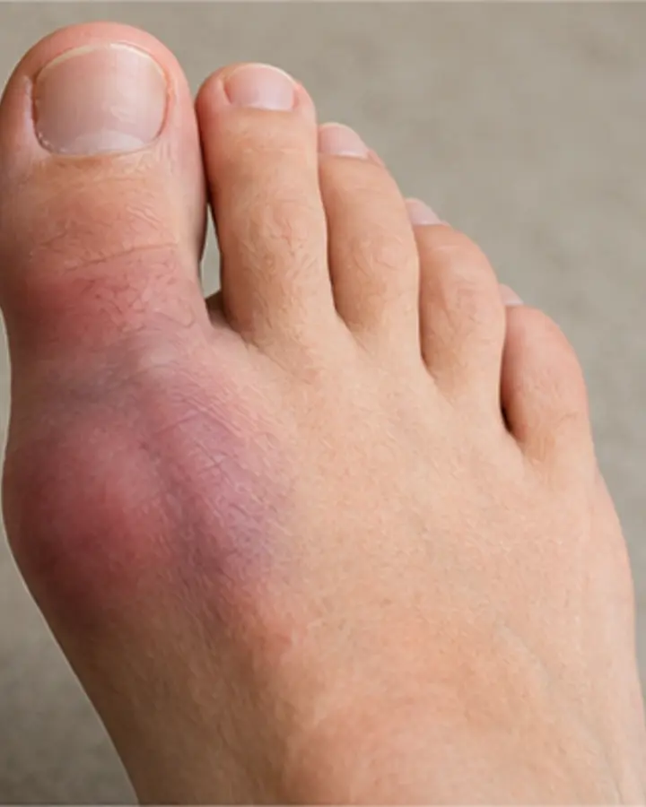 Person experiencing symptoms related to Turf toe