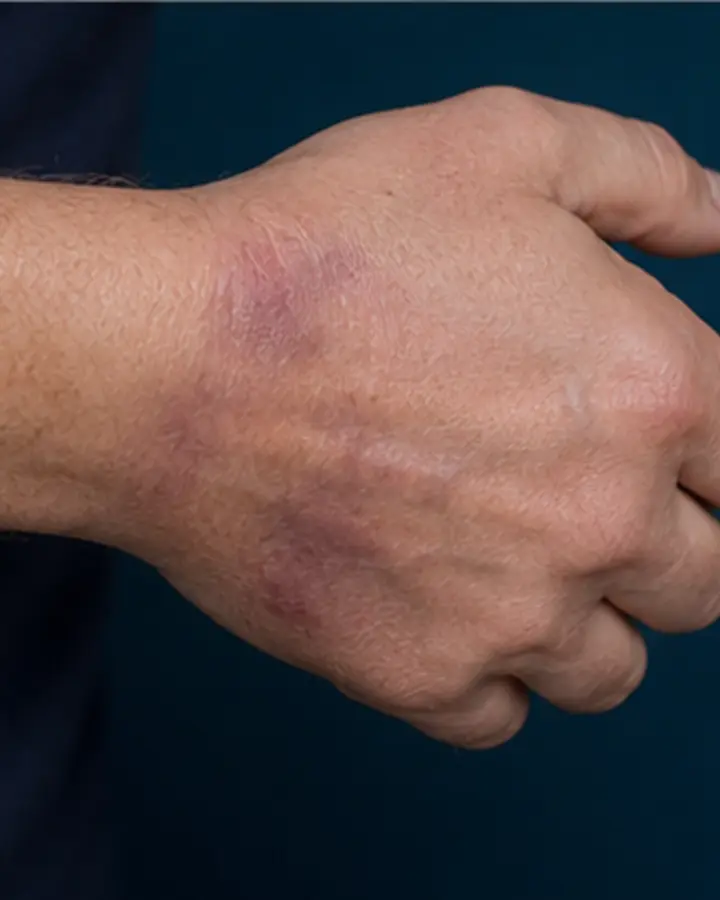 Person experiencing symptoms related to Wrist sprain